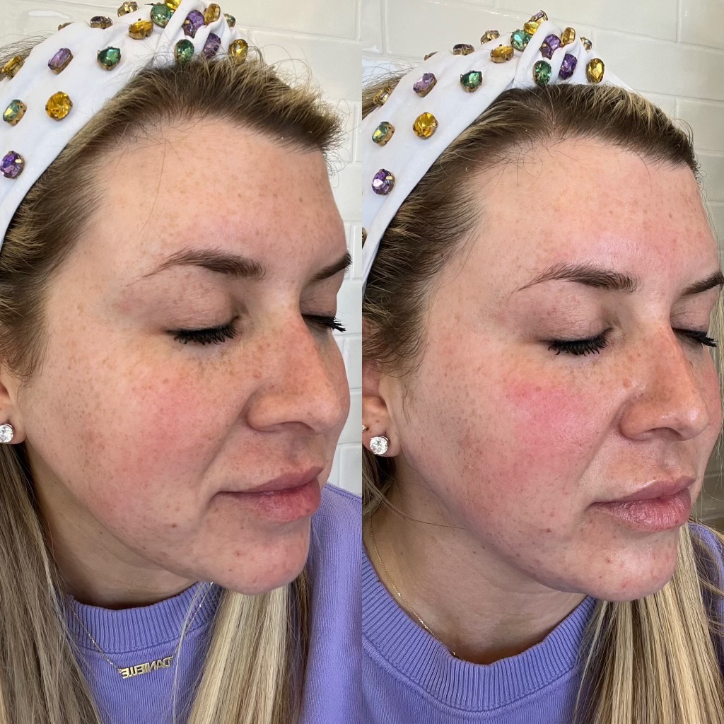 Salt Facial Before & After 3