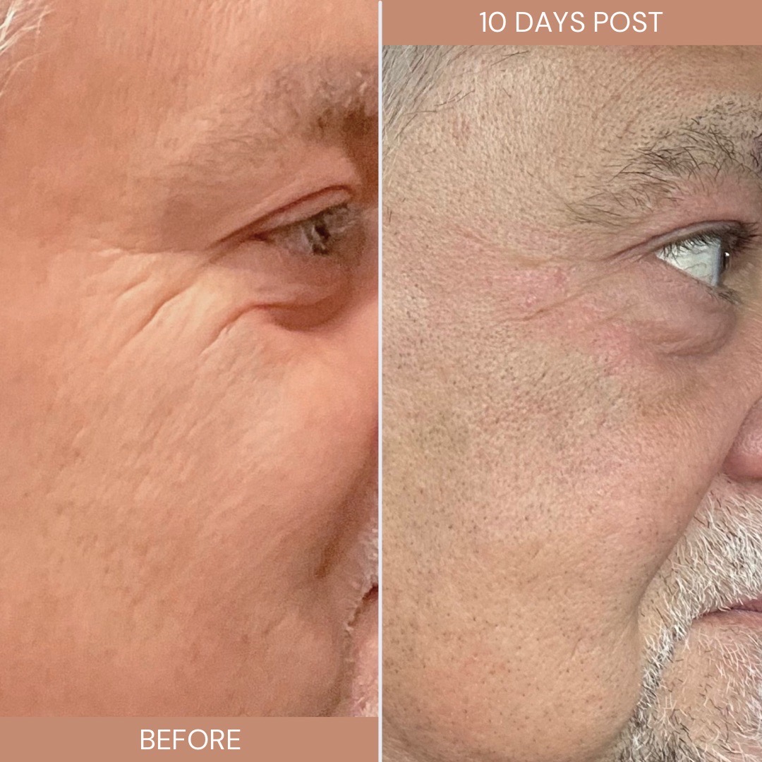 Salt Facial Before & After 2