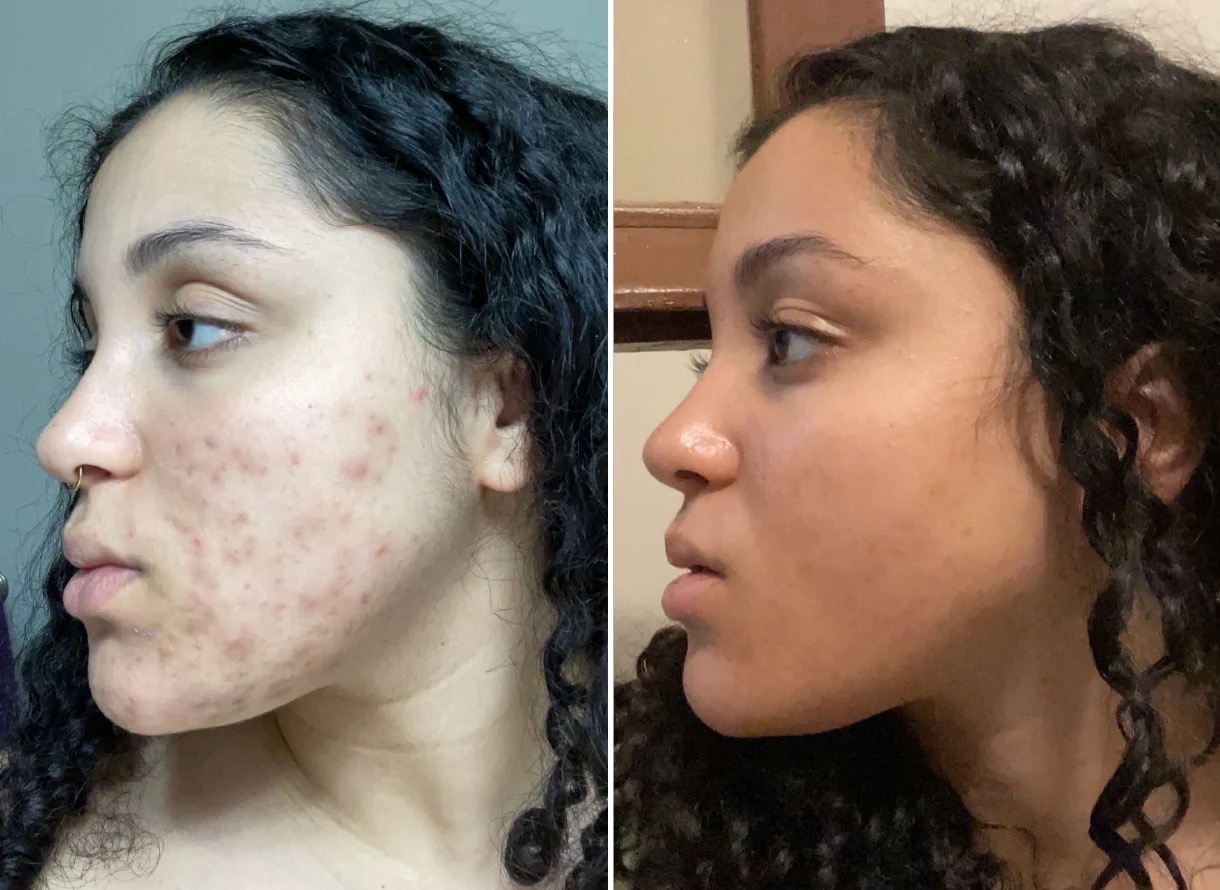 Salt Facial Before & After 1