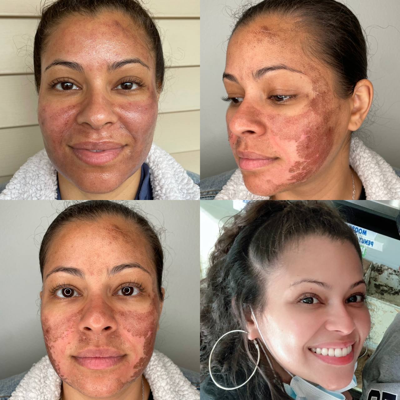 Salt Facial Before & After 2