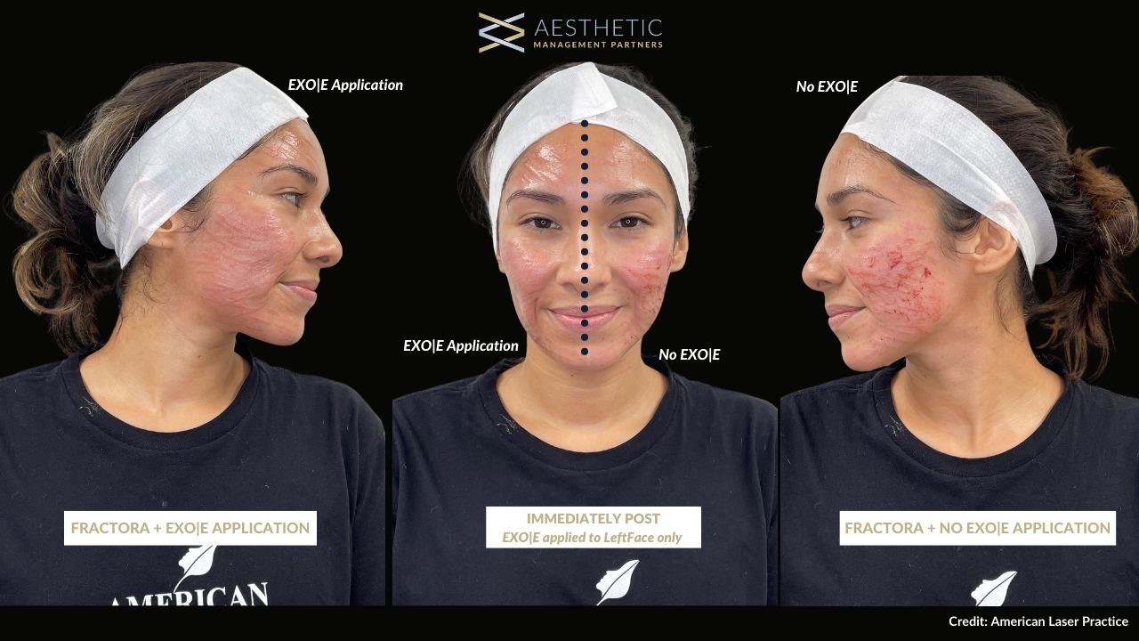 Salt Facial Before & After 1